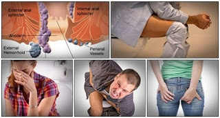 Ambeien setelah melahirkan apakah bisa sembuh, penyakit ambeien atau wasir parah, cara mengobati ambeien secara herbal, cara mengatasi wasir sesudah melahirkan, mengobati wasir secara tuntas, obat wasir super ampuh, mengatasi wasir pada kehamilan, obat wasir atau ambeien yg aman buat ibu hamil, mengatasi wasir atau ambeien pada kehamilan, obat tradisional ambeyen pada ibu hamil, penyakit wasir atau ambeien obatnya